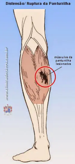 Distensão da Panturrilha - Músculo lesionado