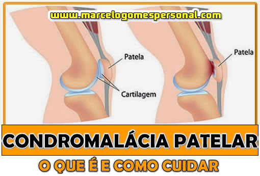 O Que é a Condromalácia Patelar e Como Cuidar?