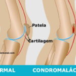 condromalácia patelar