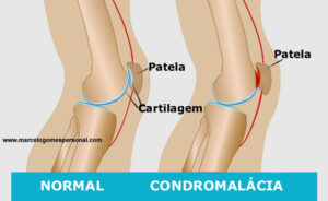 condromalácia patelar