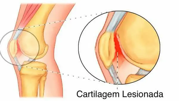 condromalácia patelar - cartilagem lesionada